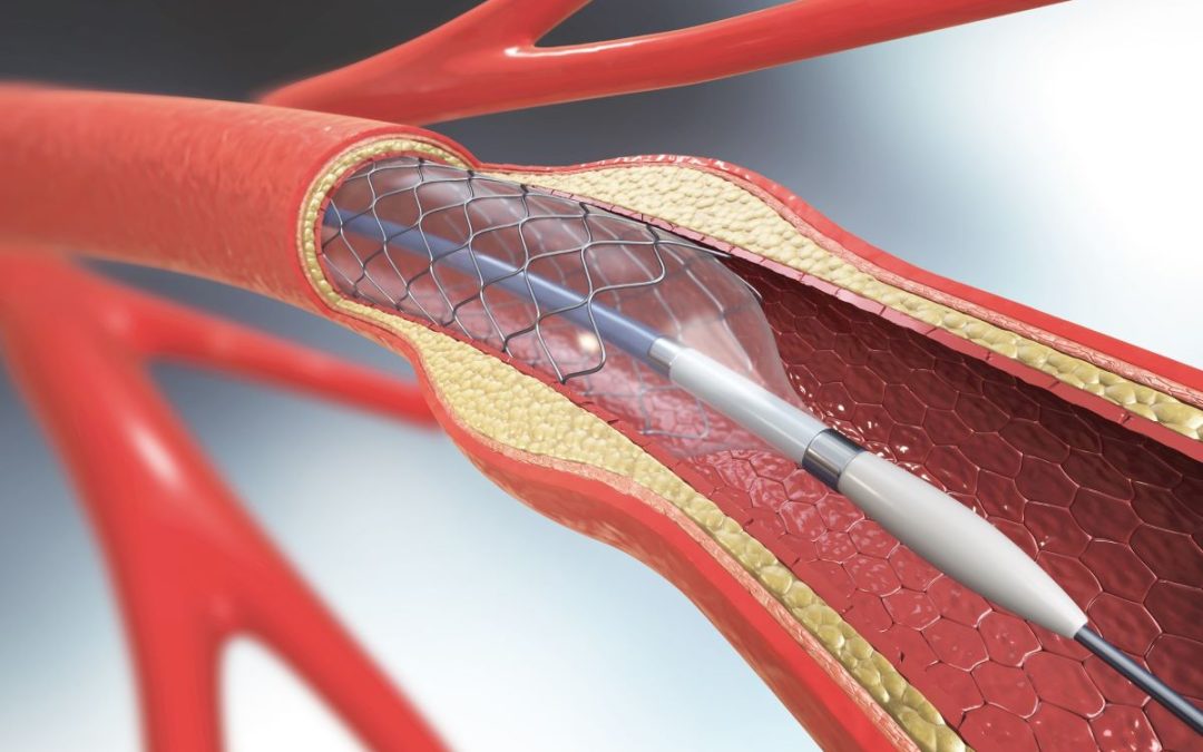 Life After Angioplasty: 5 Essential Tips to Prevent Stent Re-Blockage in 2026